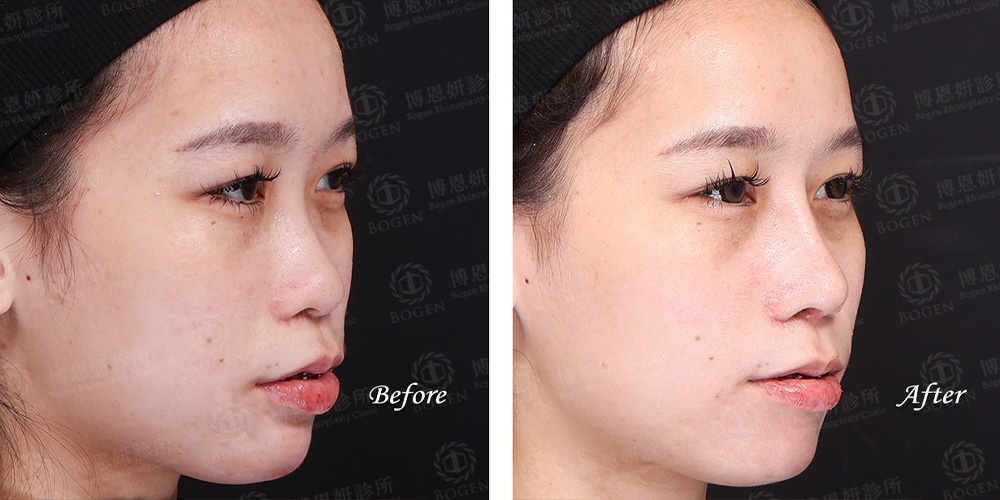 韓式隆鼻,結構式隆鼻,FITME完形美,博恩妍